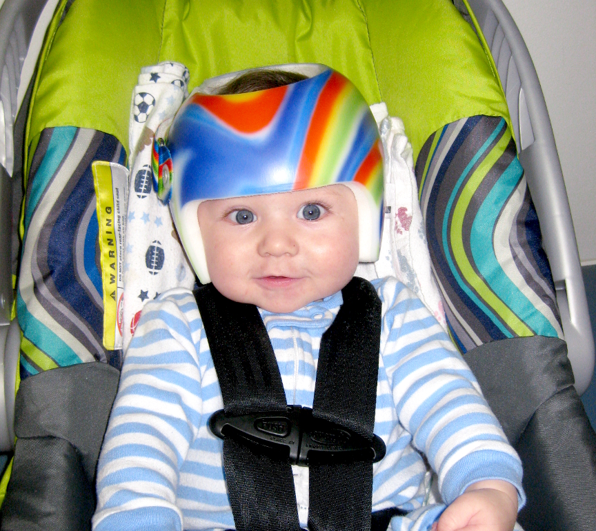 Cranial Remolding Helmets Northern Care, Inc, Prosthetics & Orthotics