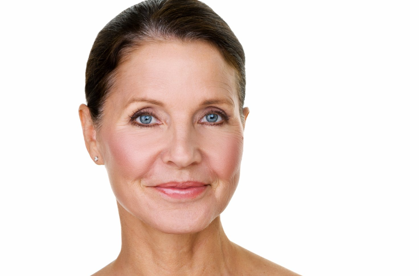 Crows Feet Treatment Dermal Fillers Crosby The Aesthetics Hub