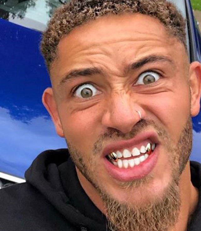 Custom made grillz Leicester Gold Teeth 1st Impressions