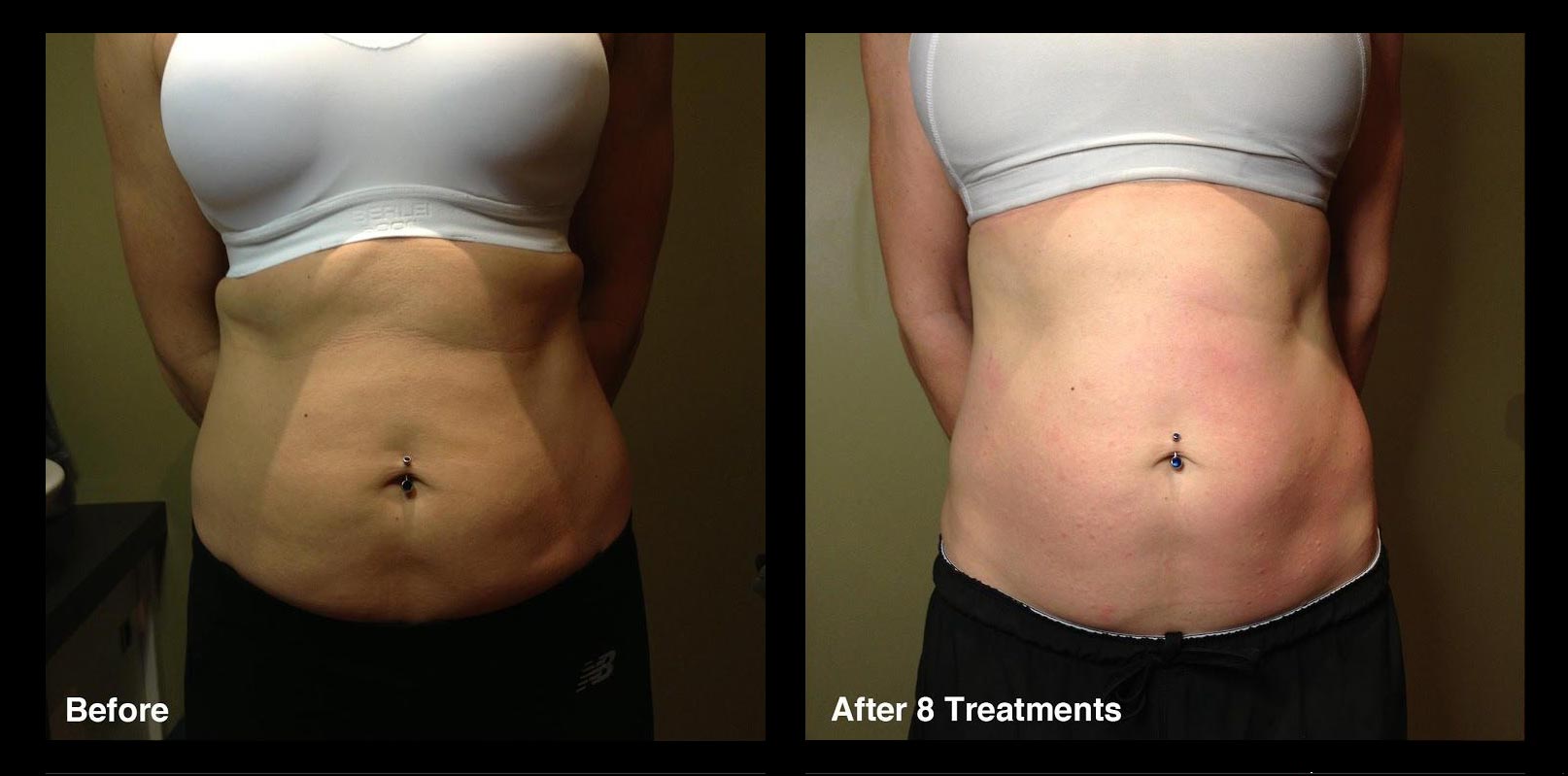 before and after belly 2