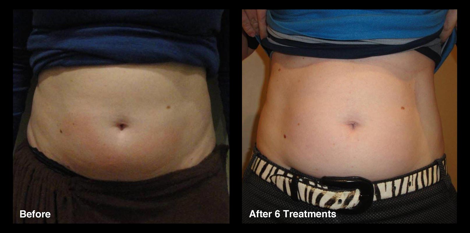 Before and After belly