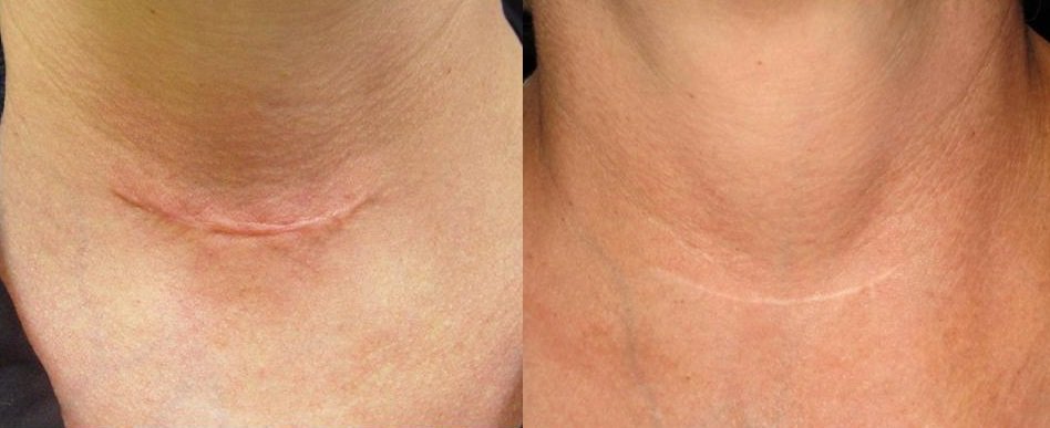 Combination therapy of Laser and Micro-needling to Heal Surgical Scars