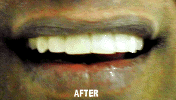 After Tooth Crowning — Sequim, WA — Sequim Advanced Dental, Dr. Brooksby
