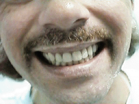 After Fixing Teeth — Sequim, WA — Sequim Advanced Dental, Dr. Brooksby