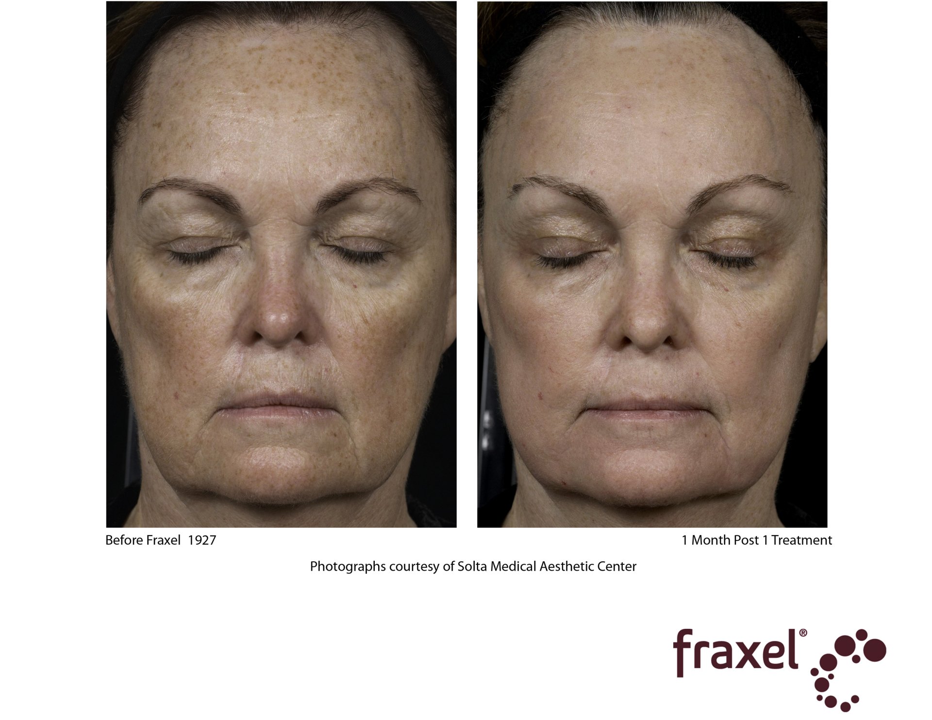 FRAXEL LASER FOLSOM DERMATOLOGY FOLSOM, CA