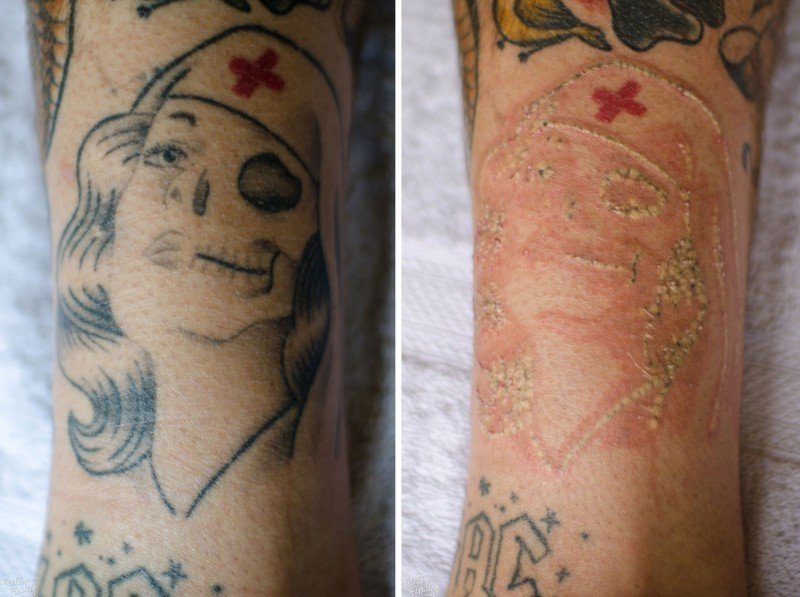 how much does it cost to get a tattoo removed in australia how much does it cost to get a tattoo removed in australia