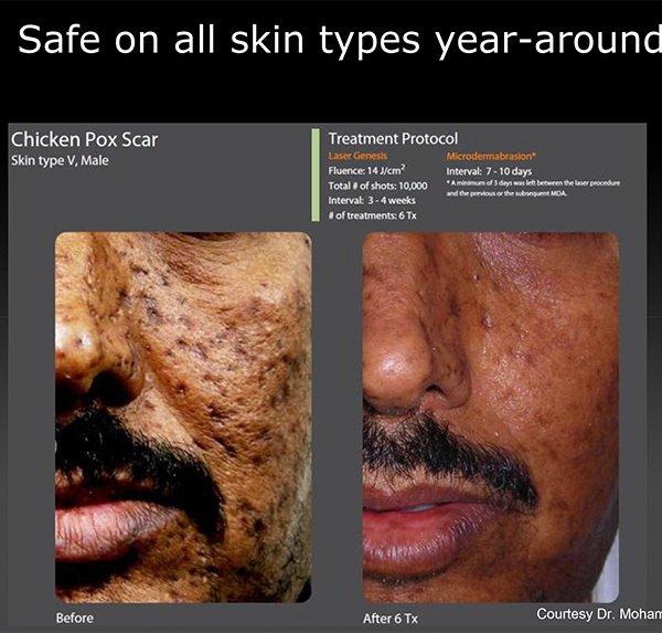 Laser Genesis Kamloops, BC SKIN