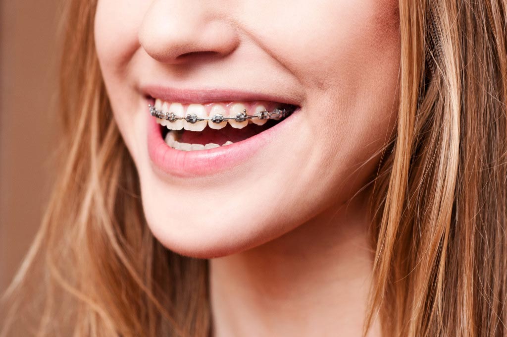 girl smiling with braces