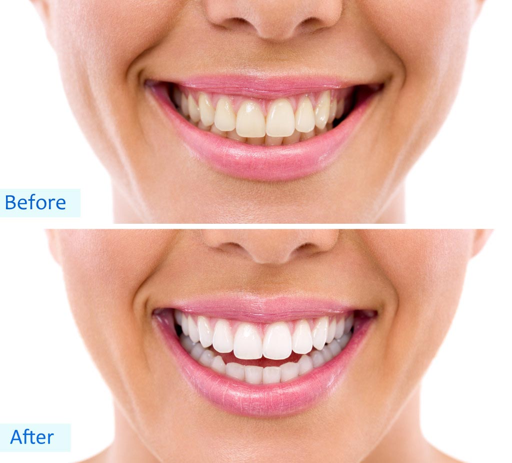 before and after teeth whitening