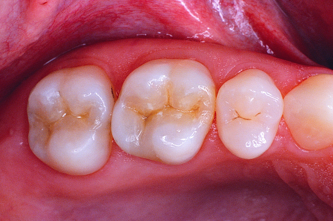 Bright Smiles Dental NonMetal Tooth Bonding & Fillings