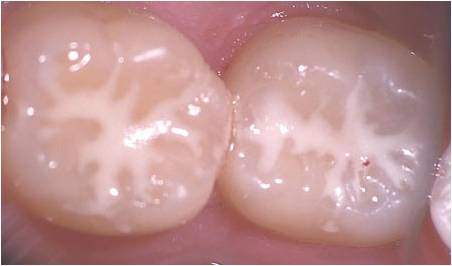 Blackwood Smiles Fissure Sealants