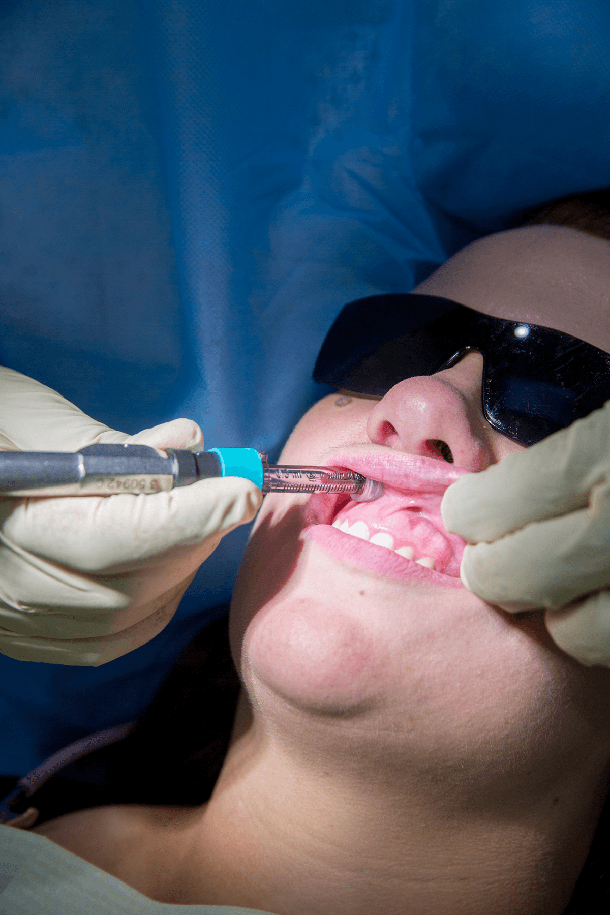 Blackwood Smiles Laser Treament