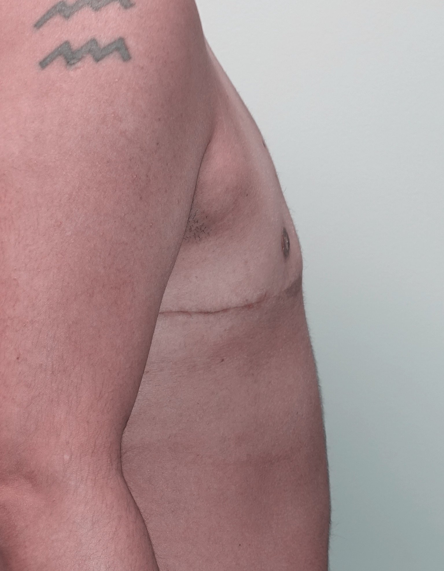 Top Surgery Gallery - Chandler Plastic Surgery