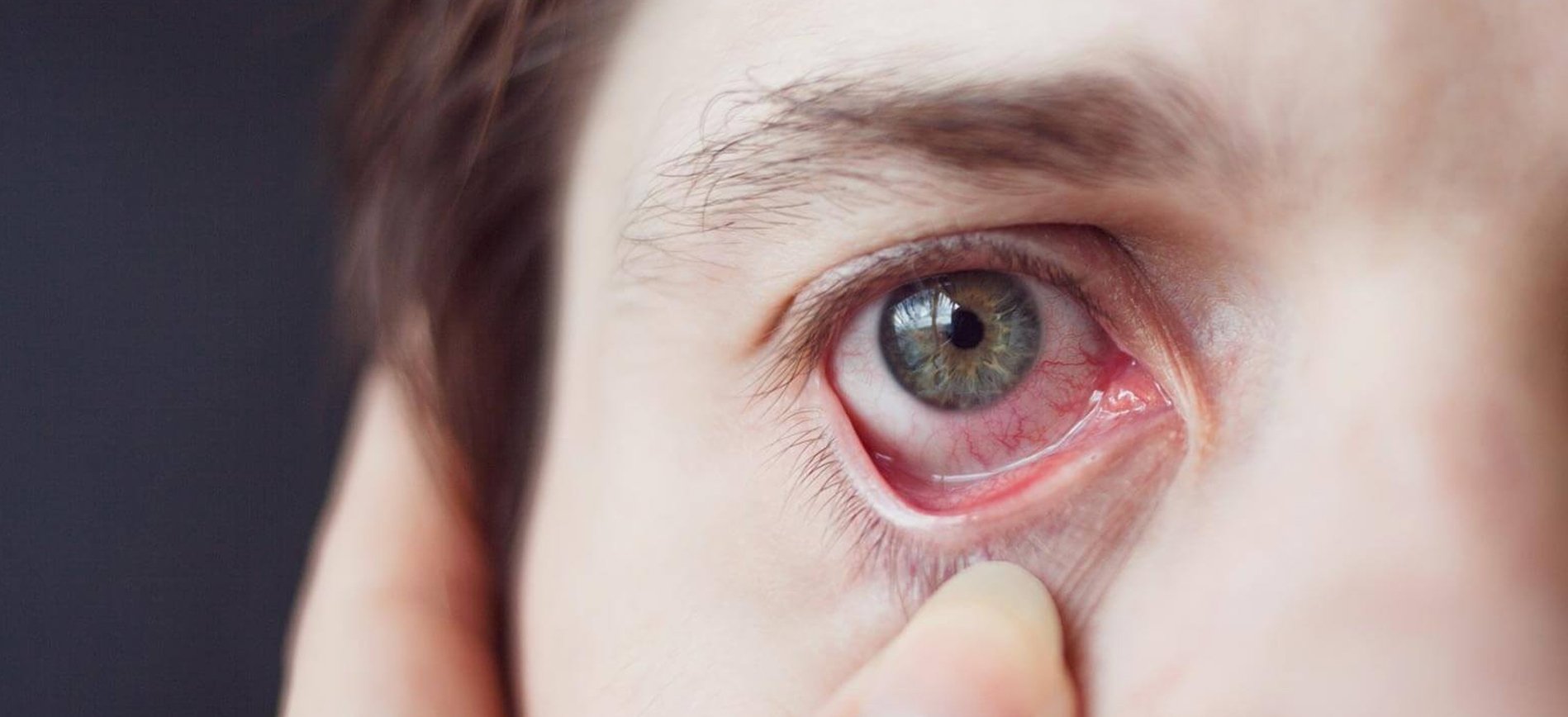 Foto de um  corpo estranho nos olhos