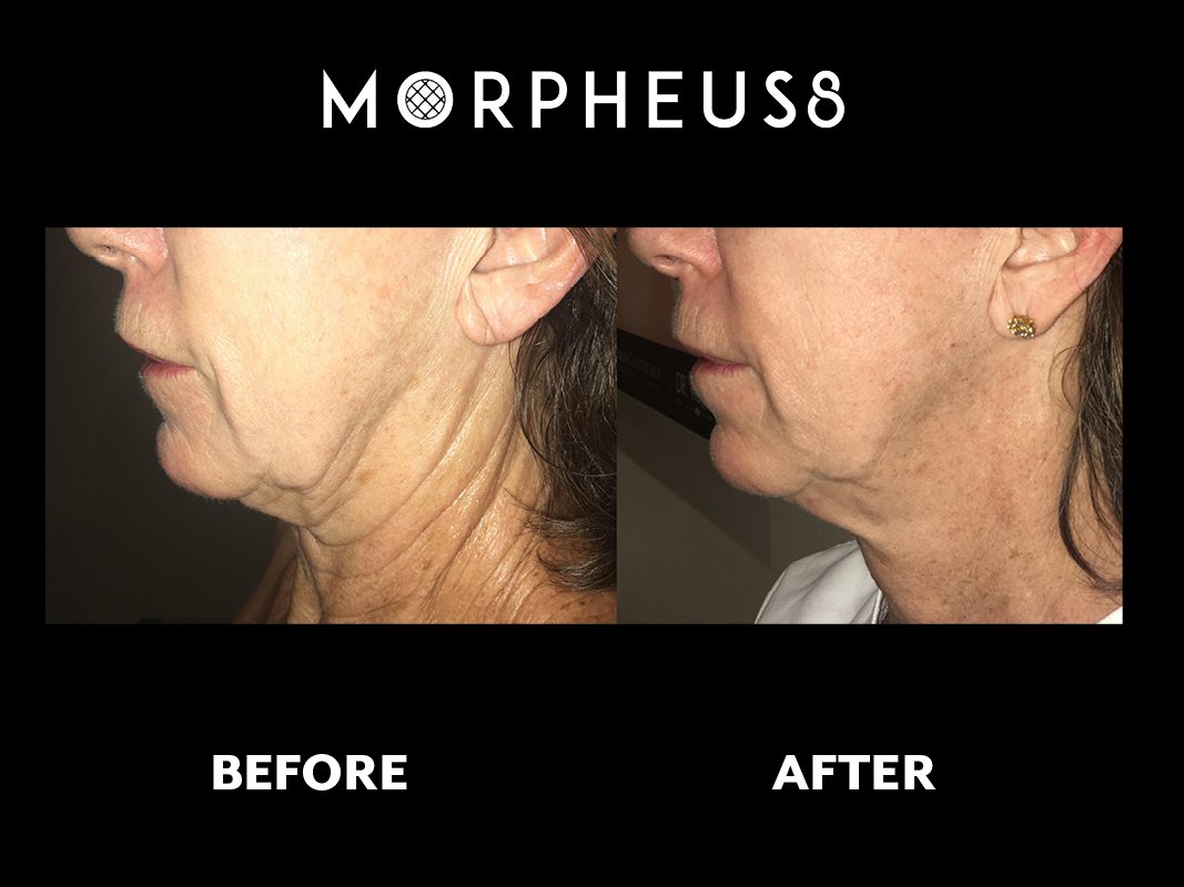 Микроигольчатый лифтинг morpheus. Микроигольчатый лифтинг morpheus