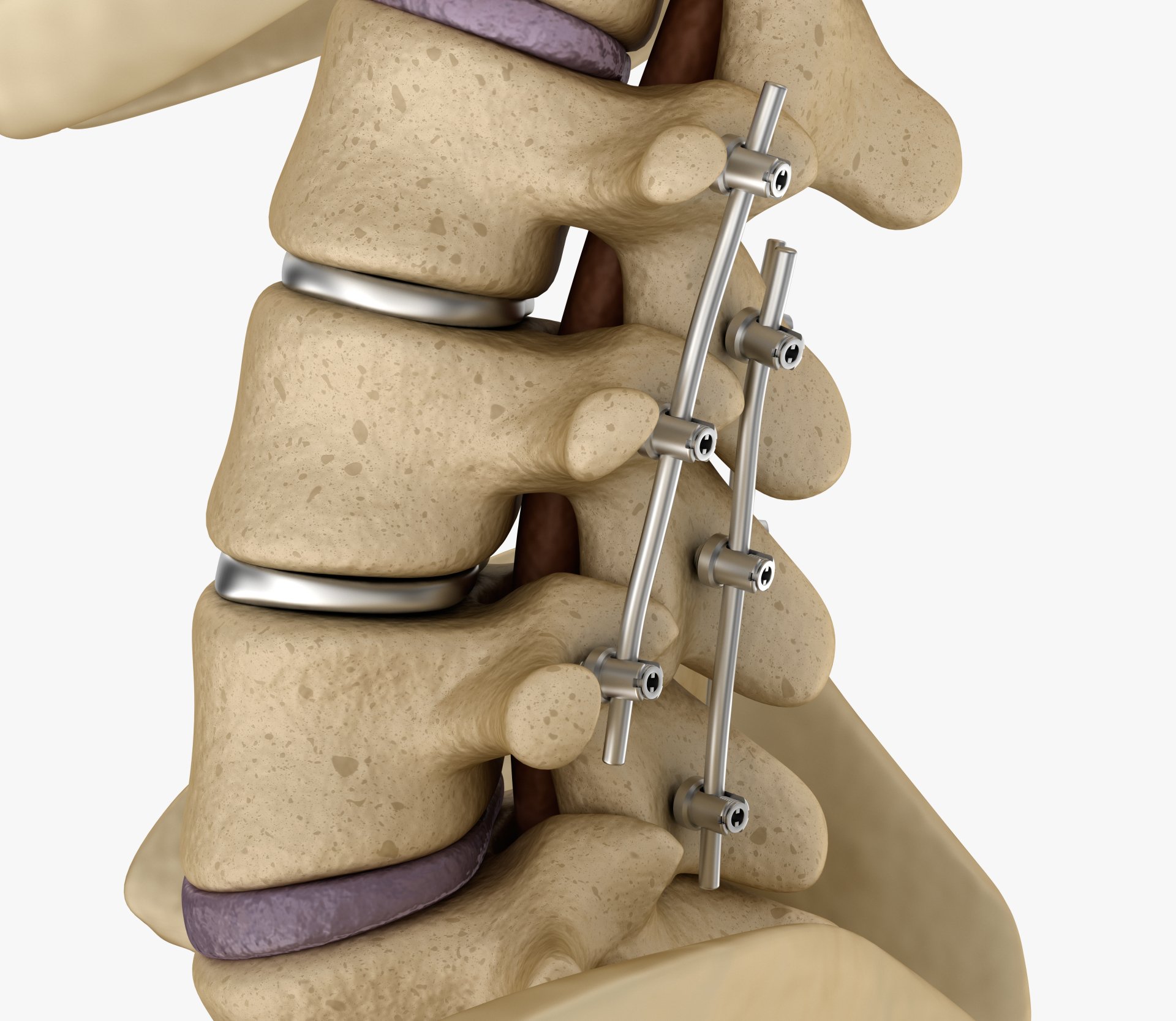Complications Of Spine Surgery Cromwell Family Chiropractic Complications Of Spine Surgery Cromwell Family Chiropractic