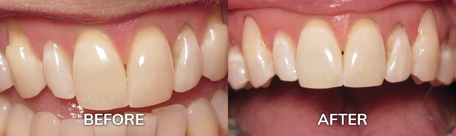 Dental Bonding for Sensitive Teeth | Before and After Photo | Tuscaloosa AL 35401