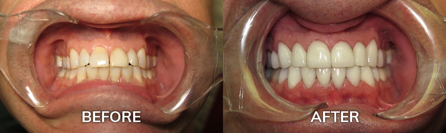Full Arch Reconstruction | Before and After Photo | Dentist in Tuscaloosa AL 35401