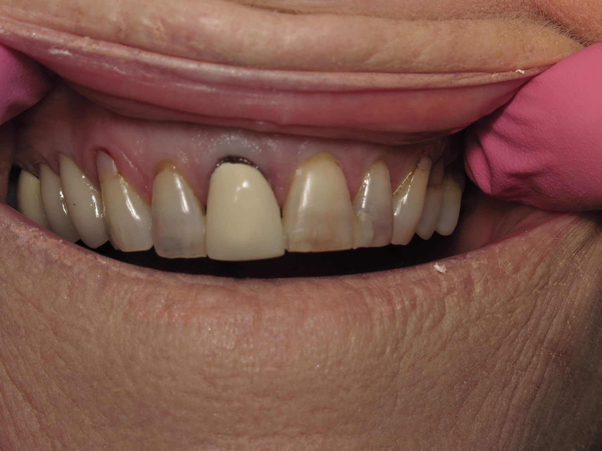 Dental Bonding Sensitive Teeth Before Photo | Tuscaloosa AL 35401