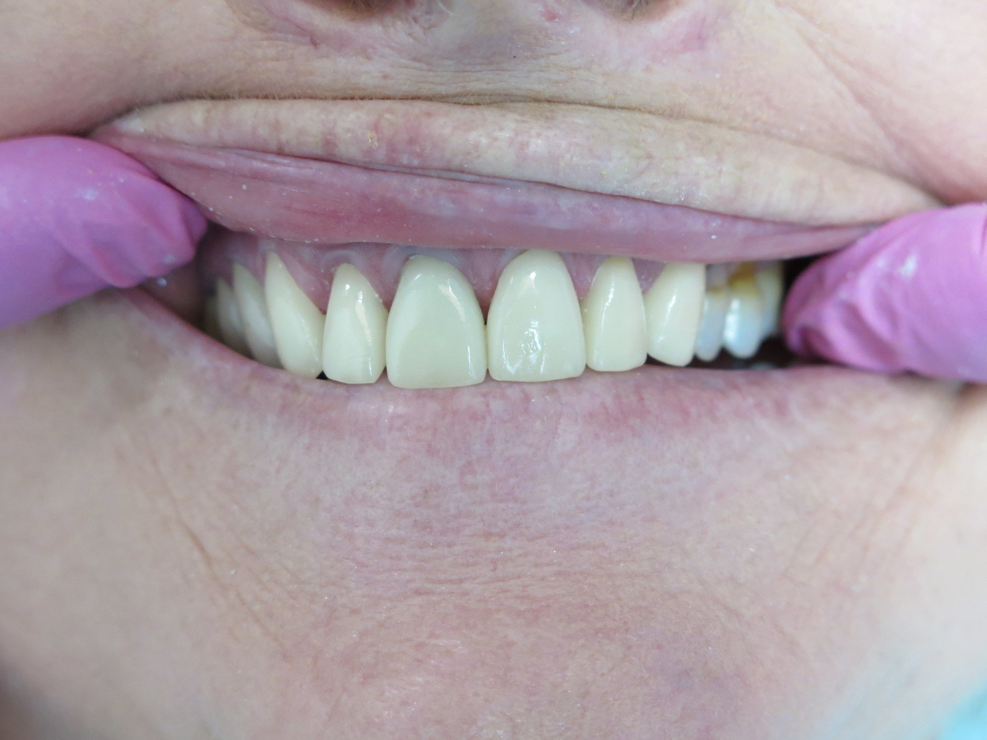 Bonding Sensitive Teeth | After Photo | Dentist Tuscaloosa AL 35401