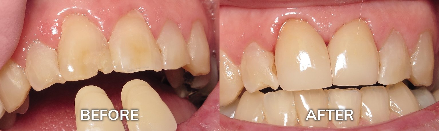 Porcelain Crowns | Dental Crowns Before and After | Adult and Pediatric Dentist Tuscaloosa AL 35401