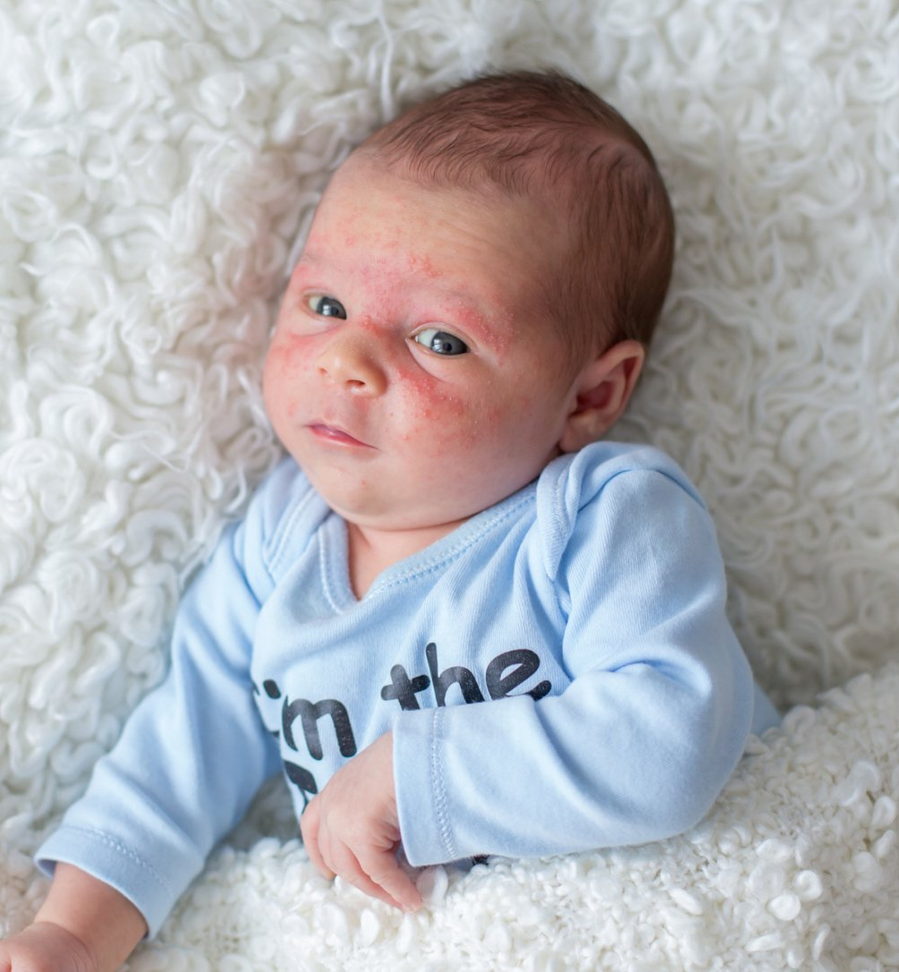 Patmore Water Softeners Ipswich, Suffolk Eczema