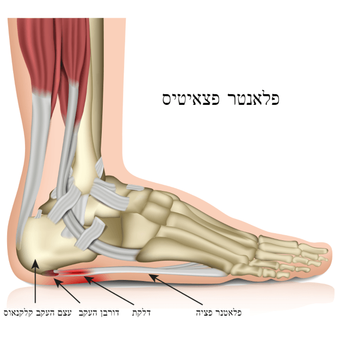 PLANTAR FASCIITIS דורבן בעקב