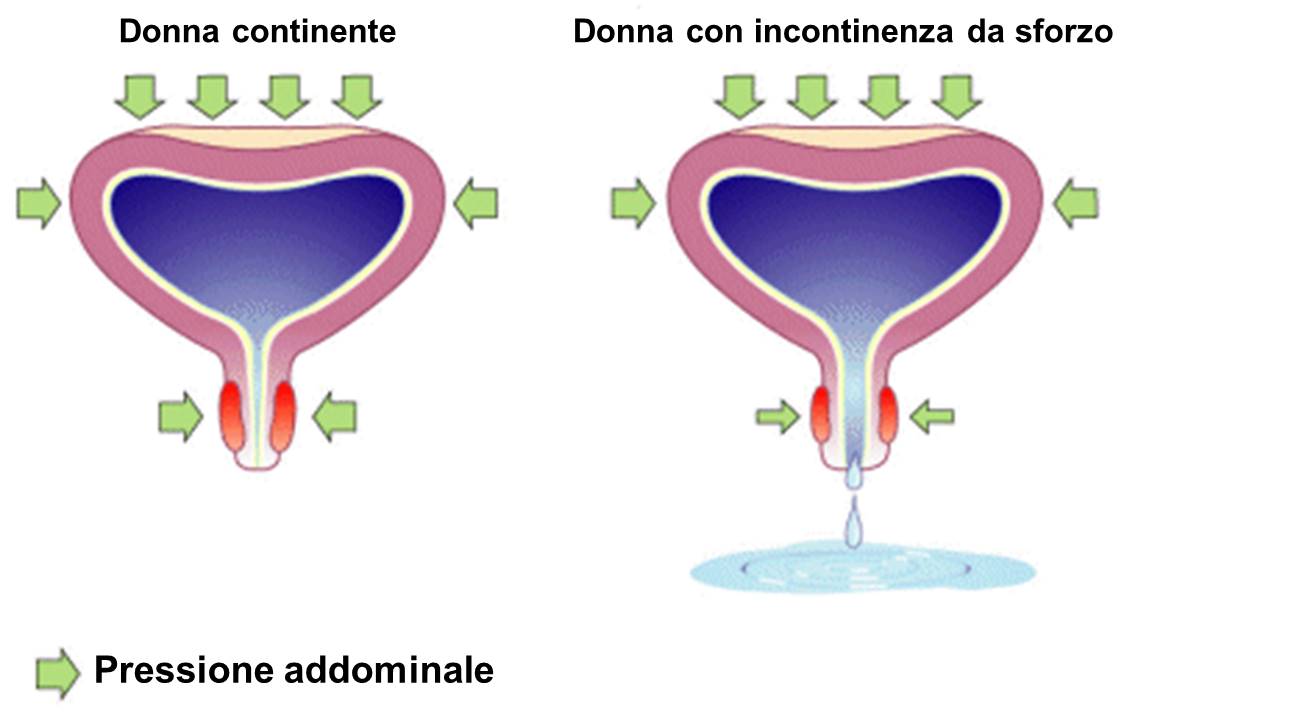 Incontinenza Urinaria In Viaggio: Come Preparare La Tua Valigia