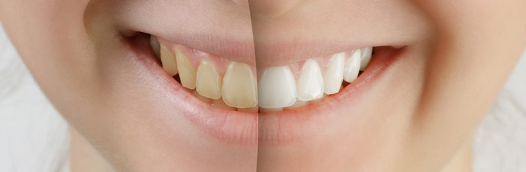 Marina Beauty teeth whitening