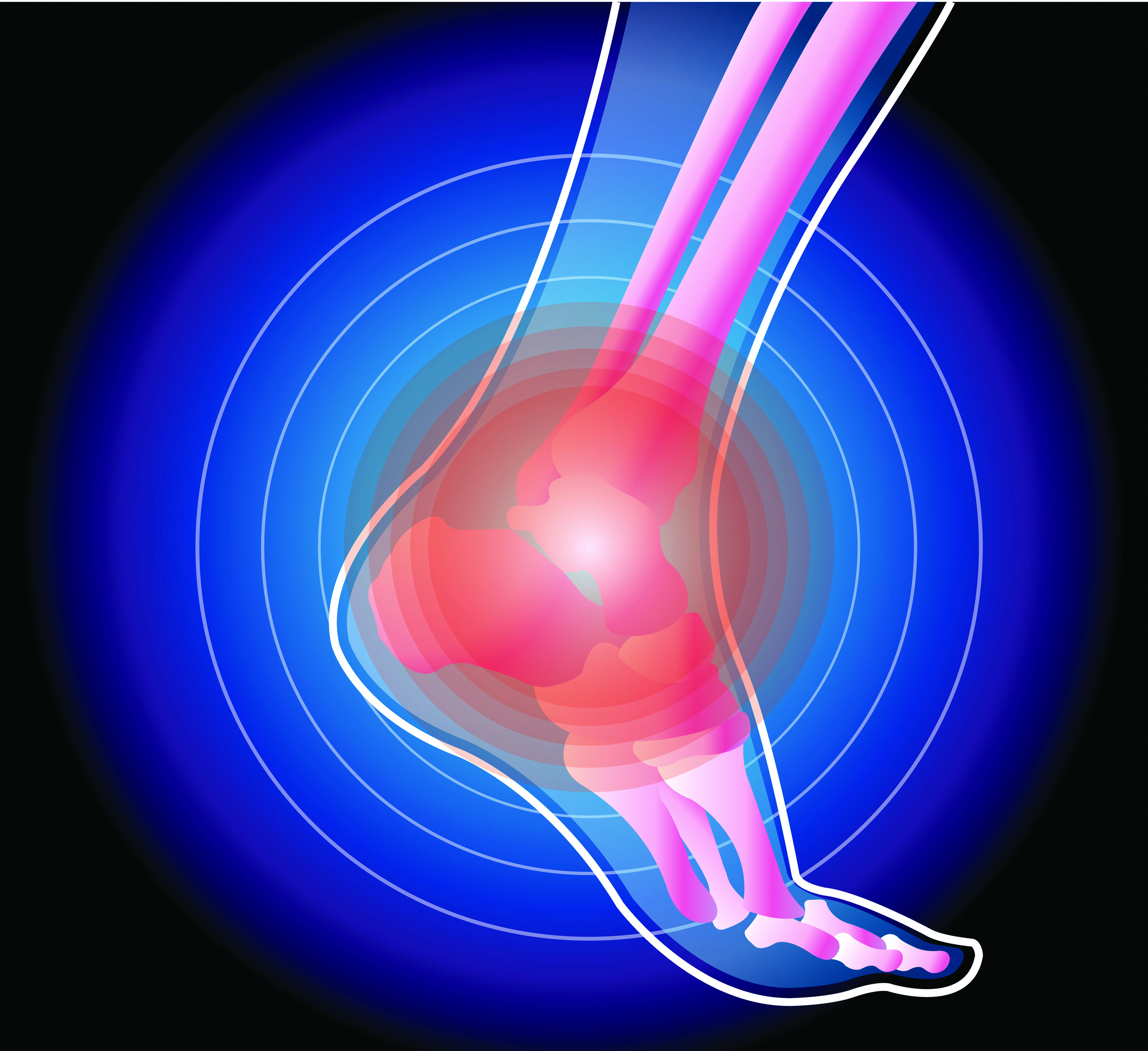 Don’t Let an Old Ankle Injury Spring Up