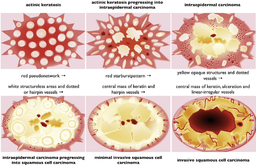 Actinic Keratosis