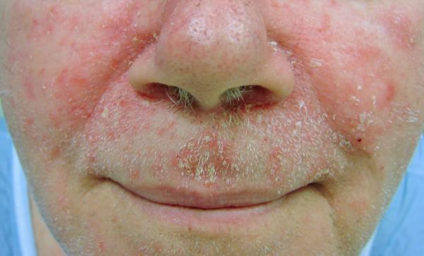 Seborrheic Eczema Face Seborrheic Eczema Face