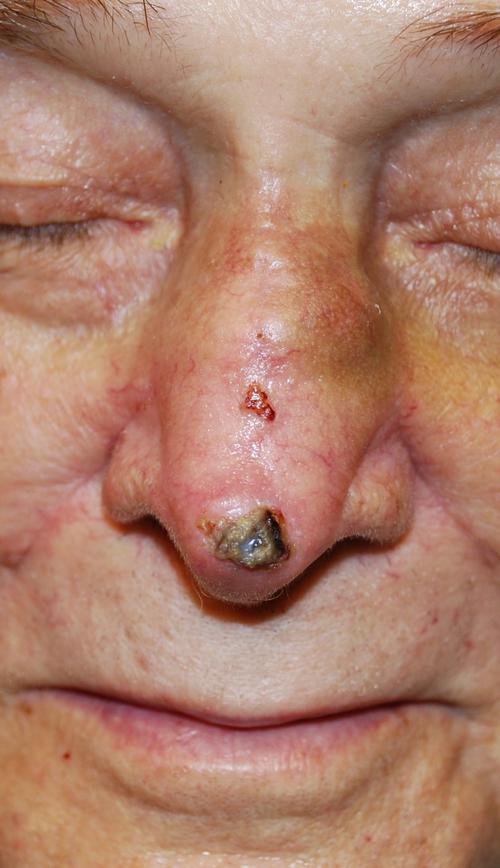 March Mohs Case Presentation Infiltrative Basal Cell On The Nose