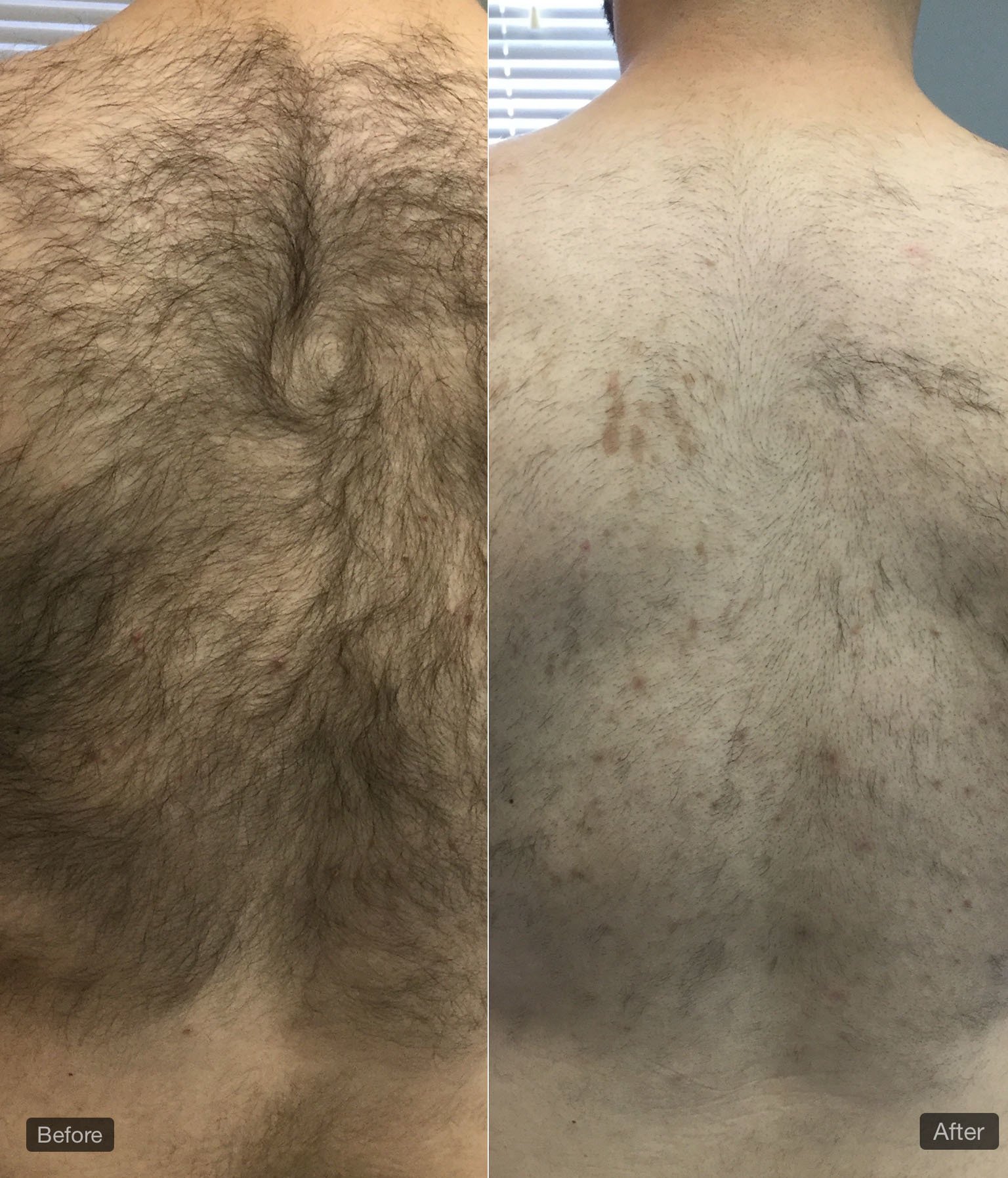 Laser Hair Removal Services Memphis Laser Clinic