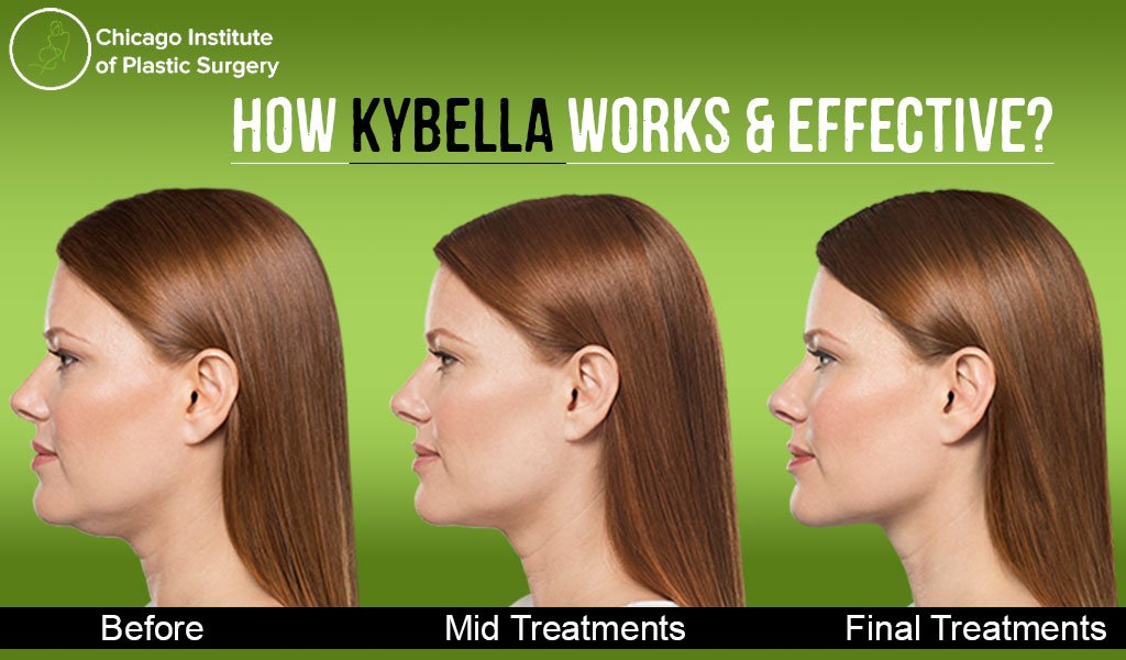 How Kybella works and why it is so effective?