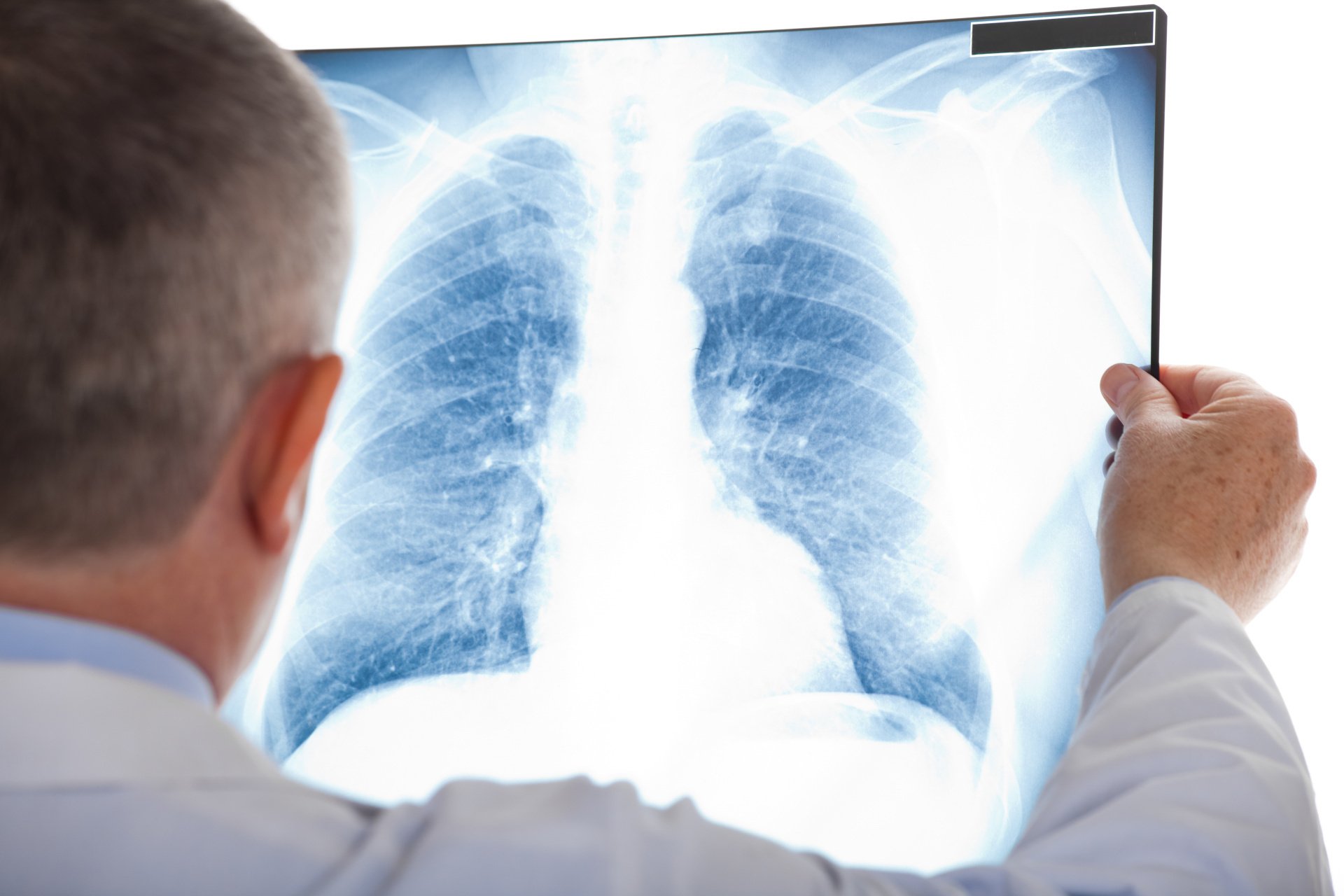 A doctor is looking at an x-ray of a person 's lungs.