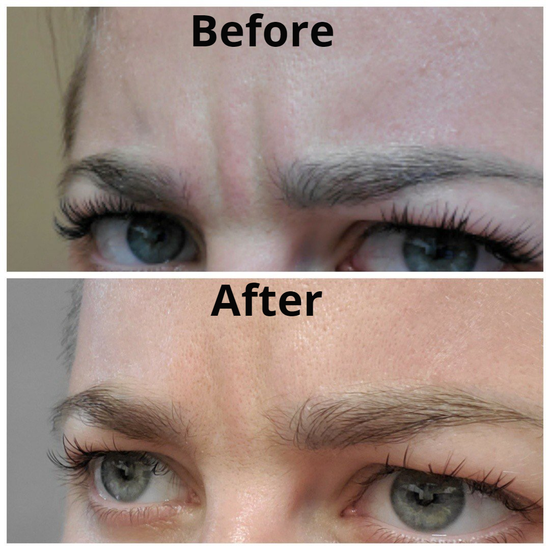 Electrolysis & Med Spa before & after Dallas, TX Hair Today Gone