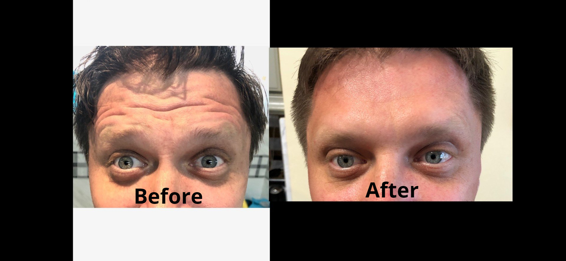 Electrolysis & Med Spa before & after Dallas, TX Hair Today Gone