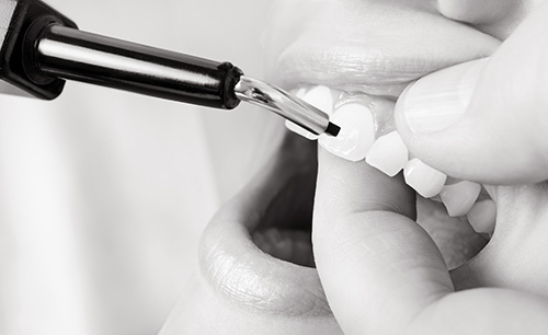 Dental services to get beautiful smile in Auckland, NZ