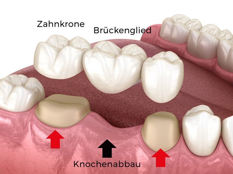 Wie Merkt Man Das Zahnbrücke Locker Ist Zahnlücke: Implantate mit Kronen oder Zahnbrücke?
