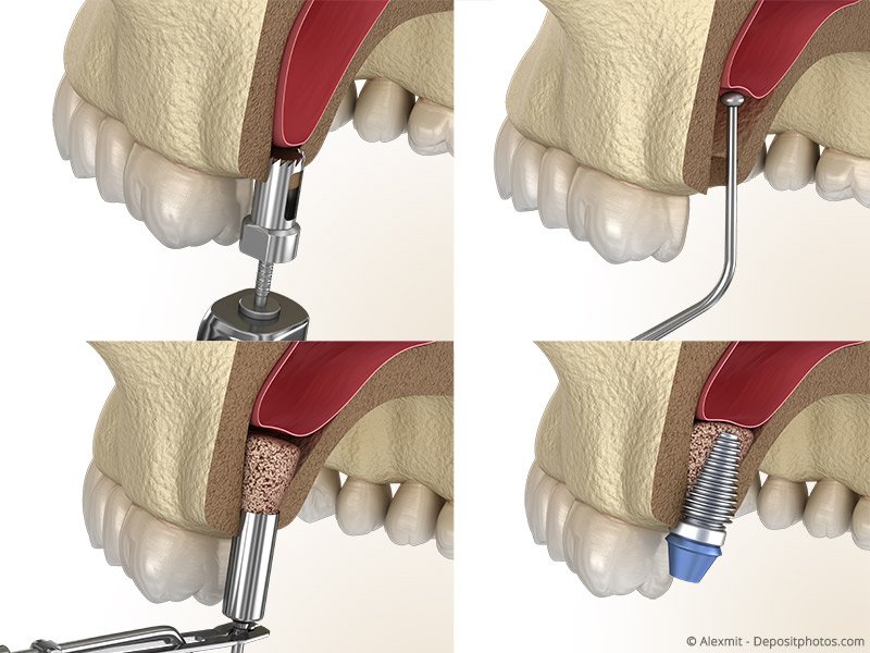Kieferknochenaufbau für Implantation - Zahnarzt Donauwörth - Dr. Bein