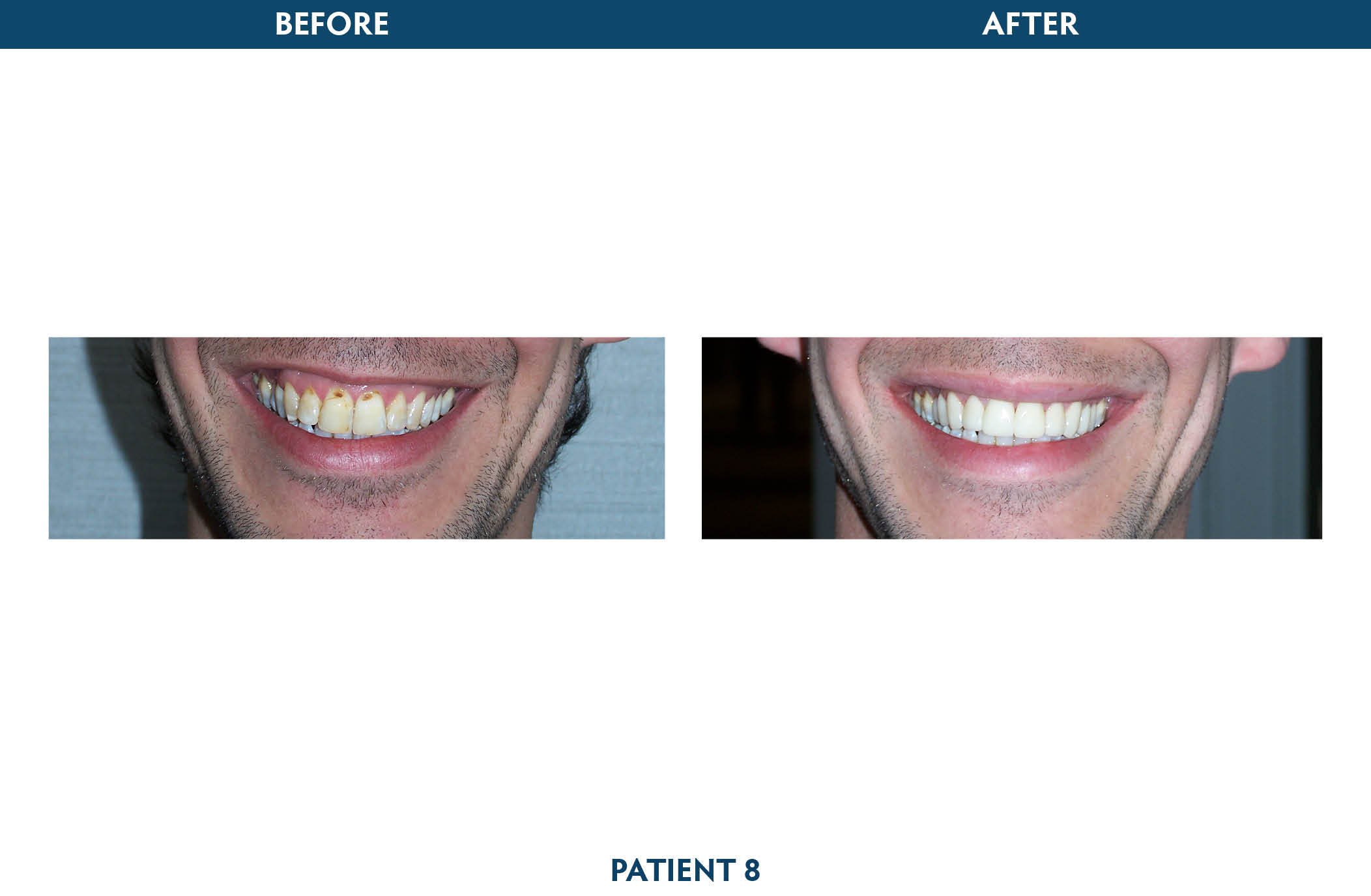 Teeth Whitening & Veneers Scarsdale & White Plains, NY - Teeth Whitening White Plains Ny