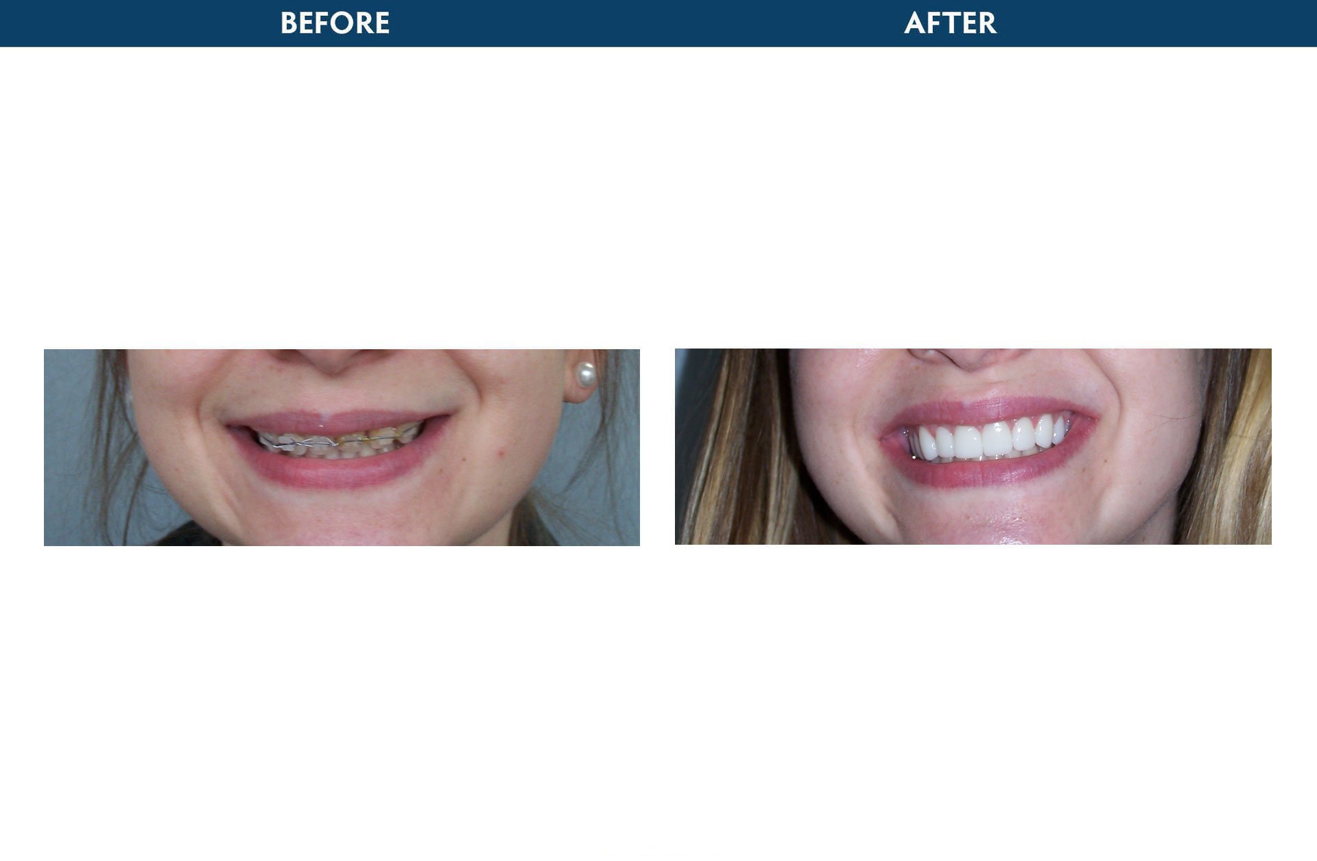 Teeth Whitening White Plains Ny